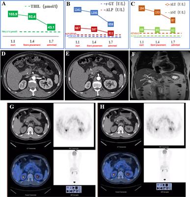 Distal extrahepatic cholangiocarcinoma mimicking groove pancreatitis: A case report and literature review